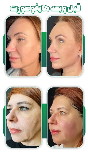  عکس قبل و بعد لاغری صورت+عکس تزریق چربی به صورت بعد از یک ماه