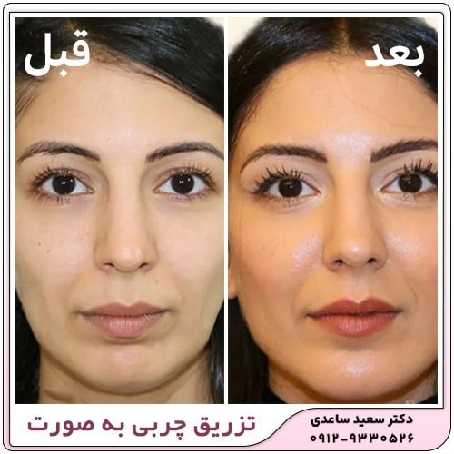  عکس قبل و بعد لاغری صورت+عکس تزریق چربی به صورت بعد از یک ماه