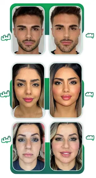  عکس قبل و بعد لاغری صورت+عکس تزریق چربی به صورت بعد از یک ماه