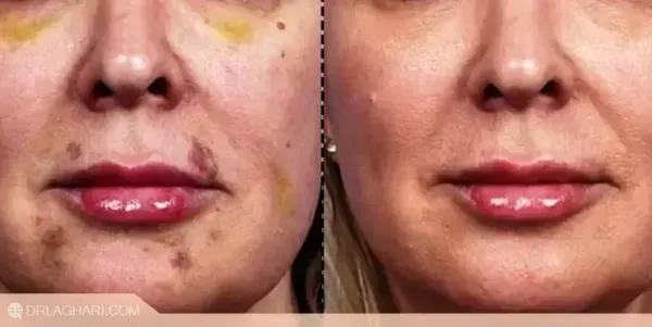 آیا بعد از تزریق چربی صورت کبود میشود+تزریق چربی به صورت چقدر ماندگاری دارد