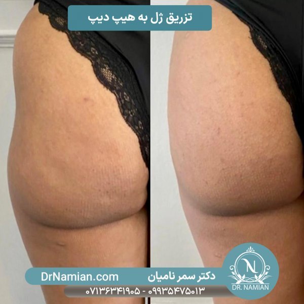  آیا بعد از تزریق چربی صورت کبود میشود+تزریق چربی به صورت چقدر ماندگاری دارد