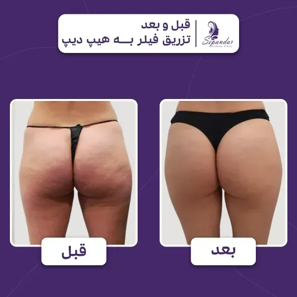  آیا بعد از تزریق چربی صورت کبود میشود+تزریق چربی به صورت چقدر ماندگاری دارد