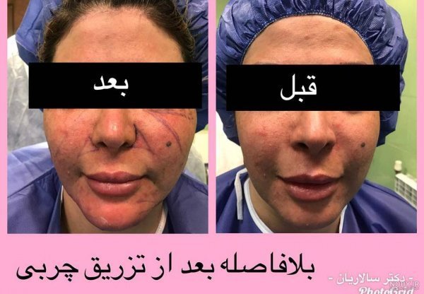  آیا بعد از تزریق چربی صورت کبود میشود+تزریق چربی به صورت چقدر ماندگاری دارد