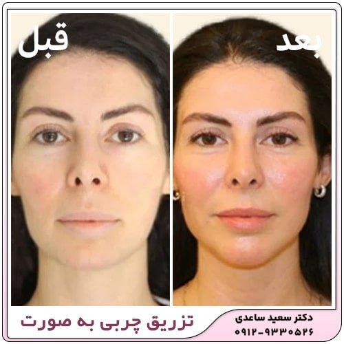  آیا بعد از تزریق چربی صورت کبود میشود+تزریق چربی به صورت چقدر ماندگاری دارد