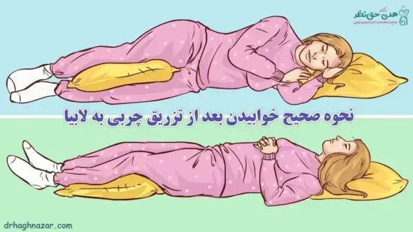  آیا بعد از تزریق چربی صورت کبود میشود+تزریق چربی به صورت چقدر ماندگاری دارد