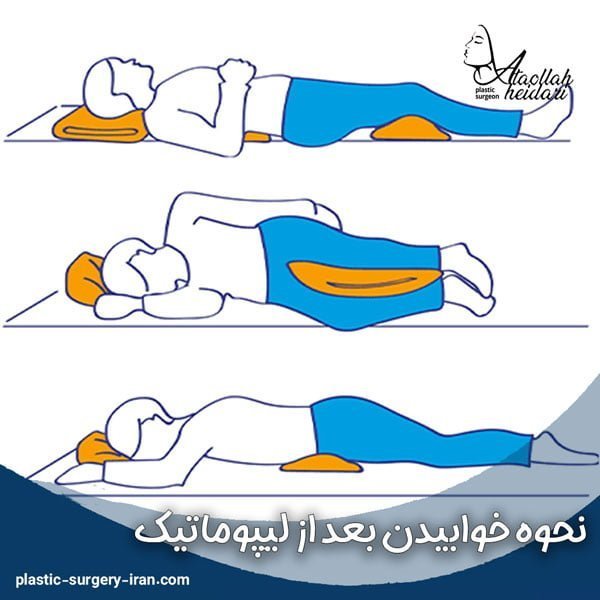  آیا بعد از تزریق چربی صورت کبود میشود+تزریق چربی به صورت چقدر ماندگاری دارد