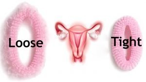  تزریق ژل به واژن چگونه انجام می‌شود+چه فیلری برای بیکینی خوبه+ژل تنگ کننده واژن