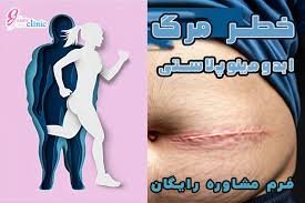  لیپو و ابدو چه فرقی دارد+عمل لیپو ابدو چقدر طول میکشد+لیپو۳۶۰ درجه یعنی چی