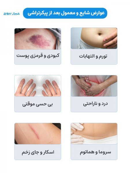  لیپو و ابدو چه فرقی دارد+عمل لیپو ابدو چقدر طول میکشد+لیپو۳۶۰ درجه یعنی چی