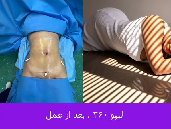 لیپو ۳۶۰ بدون ترنسفر یعنی چه+ماساژ بعد از ابدومینوپلاستی درد دارد