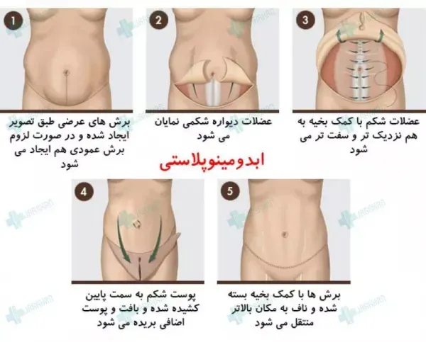  لیپو ۳۶۰ بدون ترنسفر یعنی چه+ماساژ بعد از ابدومینوپلاستی درد دارد