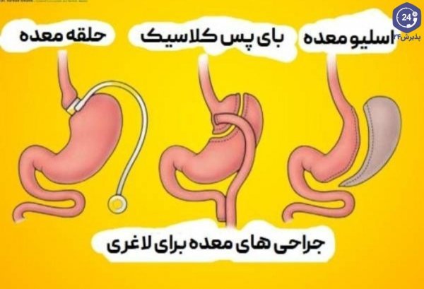  آیا لیپوماتیک خطرناک است+قبل از عمل لیپوماتیک چی بخوریم+اسلیو معده یعنی چی