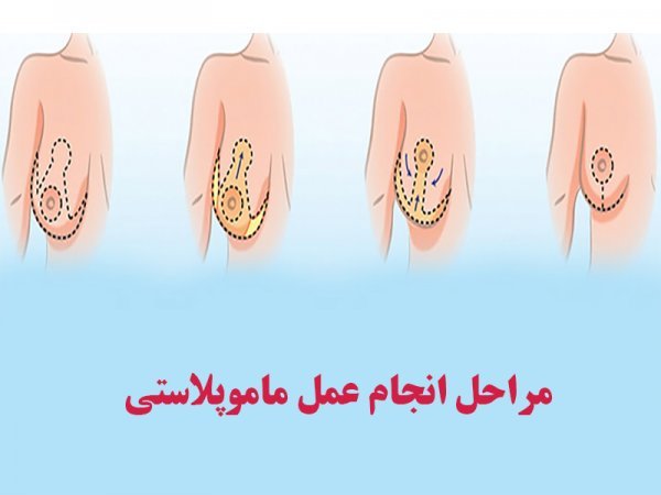  آیا لیپوماتیک خطرناک است+قبل از عمل لیپوماتیک چی بخوریم+اسلیو معده یعنی چی