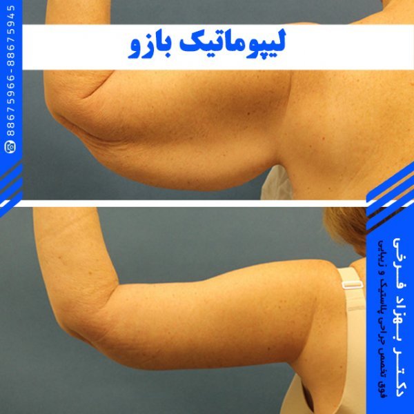 آیا لیپوماتیک بازو درد دارد+آیا لیپوماتیک ران درد دارد+بعد از اسلیو معده دوباره چاق می‌شویم+چرا بعد از عمل ابدومینوپلاستی باید گن پوشید