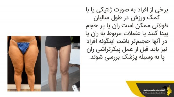  آیا لیپوماتیک بازو درد دارد+آیا لیپوماتیک ران درد دارد+بعد از اسلیو معده دوباره چاق می‌شویم+چرا بعد از عمل ابدومینوپلاستی باید گن پوشید