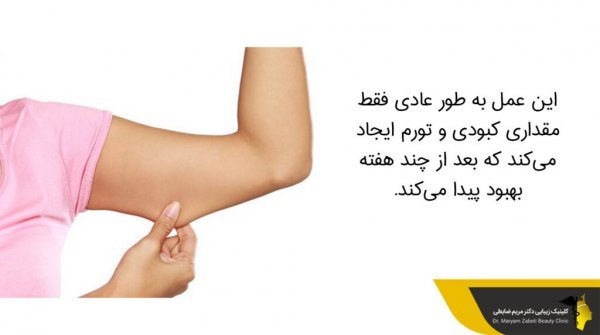  آیا لیپوماتیک بازو درد دارد+آیا لیپوماتیک ران درد دارد+بعد از اسلیو معده دوباره چاق می‌شویم+چرا بعد از عمل ابدومینوپلاستی باید گن پوشید