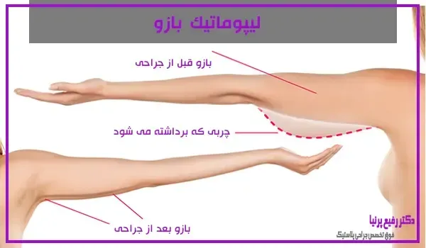  آیا لیپوماتیک بازو درد دارد+آیا لیپوماتیک ران درد دارد+بعد از اسلیو معده دوباره چاق می‌شویم+چرا بعد از عمل ابدومینوپلاستی باید گن پوشید