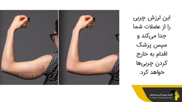  آیا لیپوماتیک بازو درد دارد+آیا لیپوماتیک ران درد دارد+بعد از اسلیو معده دوباره چاق می‌شویم+چرا بعد از عمل ابدومینوپلاستی باید گن پوشید