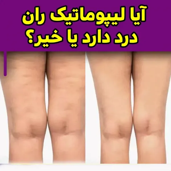  آیا لیپوماتیک بازو درد دارد+آیا لیپوماتیک ران درد دارد+بعد از اسلیو معده دوباره چاق می‌شویم+چرا بعد از عمل ابدومینوپلاستی باید گن پوشید