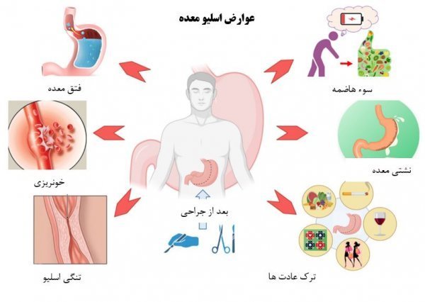 بعد از تزریق چربی صورت چه ویتامین‌هایی بخوریم+عمل اسلیو چگونه باعث لاغری میشود+آیا اسلیو معده باعث نازایی می‌شود+عوارض اسلیو معده