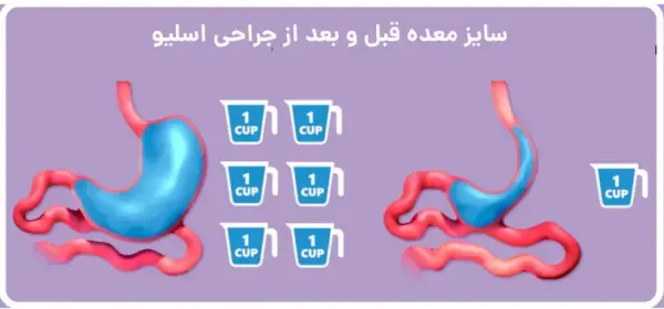  آیا بعد از اسلیو معده گشاد می‌شود+دوره نقاهت لیپوماتیک چقدر است+چه قرصی معده را کوچک می‌کند+بوتاکس معده برای چه وزنی است