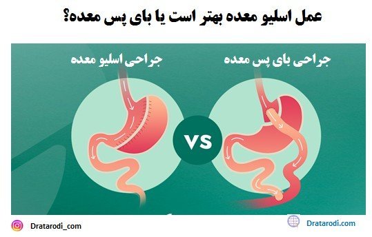  آیا بعد از اسلیو معده گشاد می‌شود+دوره نقاهت لیپوماتیک چقدر است+چه قرصی معده را کوچک می‌کند+بوتاکس معده برای چه وزنی است