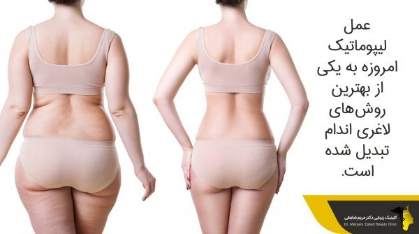  آیا بعد از اسلیو معده گشاد می‌شود+دوره نقاهت لیپوماتیک چقدر است+چه قرصی معده را کوچک می‌کند+بوتاکس معده برای چه وزنی است