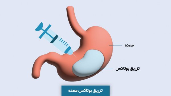  بعد از عمل اسلیو چقدر باید راه رفت+بوتاکس معده چگونه است+بوتاکس معده برای چه وزنی مناسب است+کدام عمل لاغری بدون بازگشت است