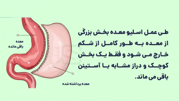  نظرات مردم درباره عمل اسلیو معده+نظرات مردم در مورد عمل معده+نظرات درباره عمل اسلیو معده+اسلیو معده برای چه کسانی خطرناک است