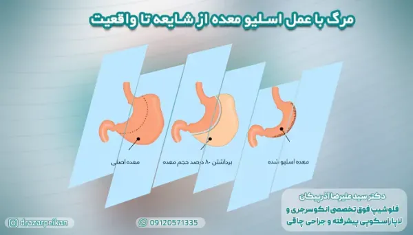  نظرات مردم درباره عمل اسلیو معده+نظرات مردم در مورد عمل معده+نظرات درباره عمل اسلیو معده+اسلیو معده برای چه کسانی خطرناک است