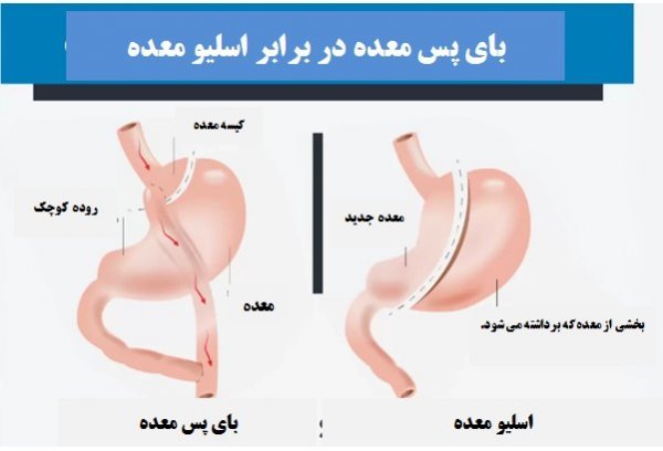  نظرات مردم درباره عمل اسلیو معده+نظرات مردم در مورد عمل معده+نظرات درباره عمل اسلیو معده+اسلیو معده برای چه کسانی خطرناک است