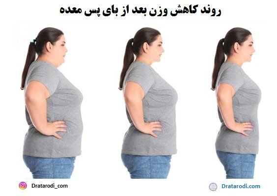 بعد از عمل بای پس چقدر وزن کم میکنیم+بعد از بای پس چه میوه هایی بخوریم+نظرات افرادی که بای پس انجام دادن+عوارض بوتاکس معده