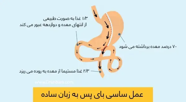  بعد از عمل بای پس چقدر وزن کم میکنیم+بعد از بای پس چه میوه هایی بخوریم+نظرات افرادی که بای پس انجام دادن+عوارض بوتاکس معده