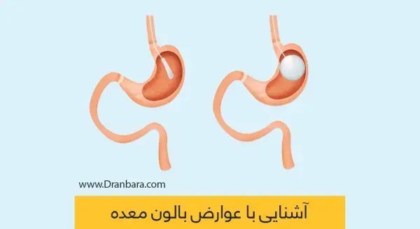  آیا بای‌پس معده عوارض دارد+چه آمپولی برای لاغری خوب است+آیا بالون معده عوارض دارد+نظرات درباره بالون معده