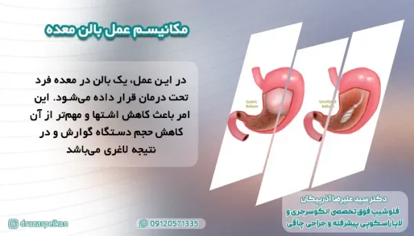  آیا بای‌پس معده عوارض دارد+چه آمپولی برای لاغری خوب است+آیا بالون معده عوارض دارد+نظرات درباره بالون معده