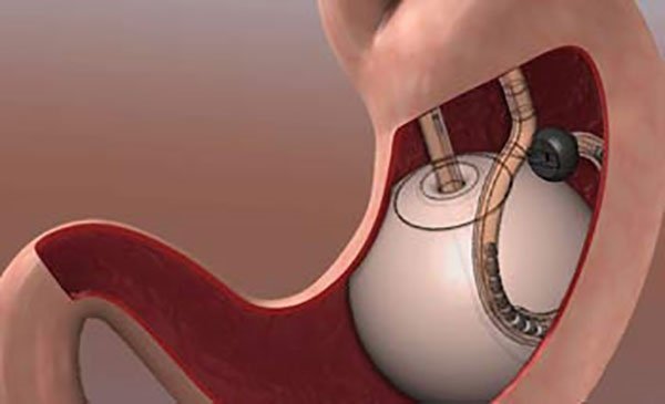  آیا بای‌پس معده عوارض دارد+چه آمپولی برای لاغری خوب است+آیا بالون معده عوارض دارد+نظرات درباره بالون معده