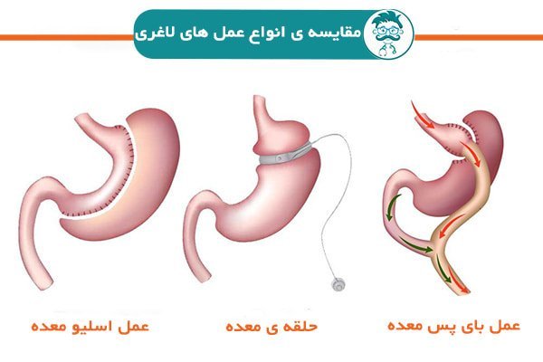  آیا بای‌پس معده عوارض دارد+چه آمپولی برای لاغری خوب است+آیا بالون معده عوارض دارد+نظرات درباره بالون معده