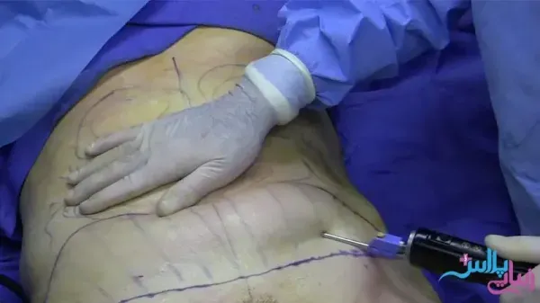  بعد از عمل بالن معده چی بخوریم+ابدو یا ابدومینوپلاستی چه عملی است+لیپوساکشن چگونه است+آیا عمل لیپوماتیک بیهوشی دارد