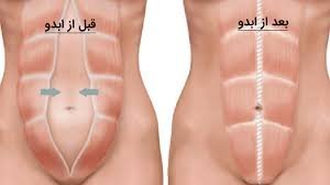  بعد از عمل بالن معده چی بخوریم+ابدو یا ابدومینوپلاستی چه عملی است+لیپوساکشن چگونه است+آیا عمل لیپوماتیک بیهوشی دارد