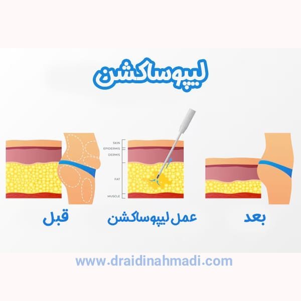  بعد از عمل بالن معده چی بخوریم+ابدو یا ابدومینوپلاستی چه عملی است+لیپوساکشن چگونه است+آیا عمل لیپوماتیک بیهوشی دارد