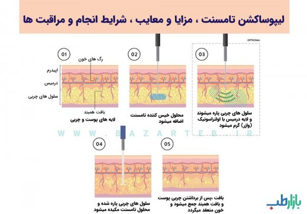  بعد از عمل بالن معده چی بخوریم+ابدو یا ابدومینوپلاستی چه عملی است+لیپوساکشن چگونه است+آیا عمل لیپوماتیک بیهوشی دارد