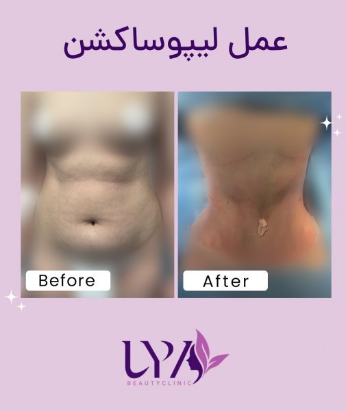  بعد از عمل بالن معده چی بخوریم+ابدو یا ابدومینوپلاستی چه عملی است+لیپوساکشن چگونه است+آیا عمل لیپوماتیک بیهوشی دارد