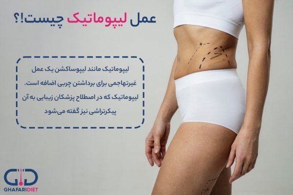 بعد از عمل بالن معده چی بخوریم+ابدو یا ابدومینوپلاستی چه عملی است+لیپوساکشن چگونه است+آیا عمل لیپوماتیک بیهوشی دارد
