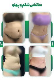 نظرات در مورد لیپوساکشن+نظرات در مورد لیپوساکشن غبغب+فیلم ساکشن غبغب+چرا بعد از ساکشن غبغب باید گن بست