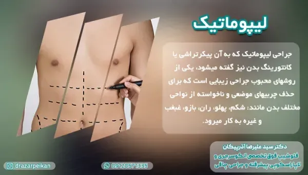  نظرات در مورد لیپوساکشن+نظرات در مورد لیپوساکشن غبغب+فیلم ساکشن غبغب+چرا بعد از ساکشن غبغب باید گن بست