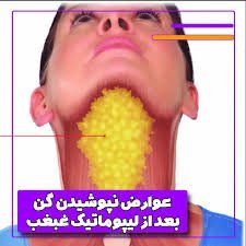  نظرات در مورد لیپوساکشن+نظرات در مورد لیپوساکشن غبغب+فیلم ساکشن غبغب+چرا بعد از ساکشن غبغب باید گن بست