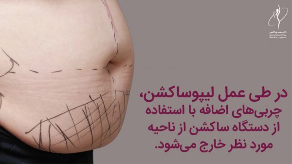  نظرات در مورد لیپوساکشن+نظرات در مورد لیپوساکشن غبغب+فیلم ساکشن غبغب+چرا بعد از ساکشن غبغب باید گن بست