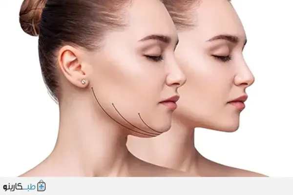  نظرات در مورد لیپوساکشن+نظرات در مورد لیپوساکشن غبغب+فیلم ساکشن غبغب+چرا بعد از ساکشن غبغب باید گن بست