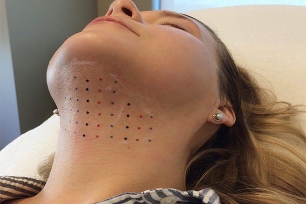  نظرات در مورد لیپوساکشن+نظرات در مورد لیپوساکشن غبغب+فیلم ساکشن غبغب+چرا بعد از ساکشن غبغب باید گن بست