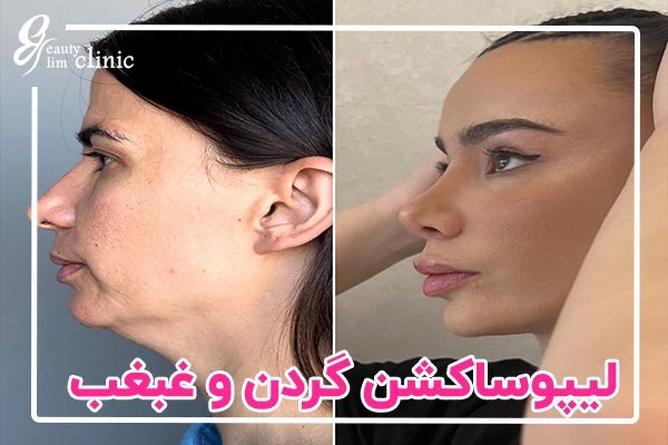  نظرات در مورد لیپوساکشن+نظرات در مورد لیپوساکشن غبغب+فیلم ساکشن غبغب+چرا بعد از ساکشن غبغب باید گن بست